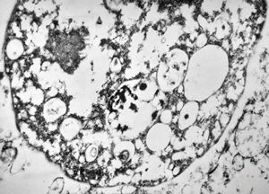 M,46y. | Entamoeba histolytica M,46y. | Entamoeba histolytica